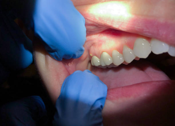 Best Emergency Treatment for Dental Infections or Abscesses in Watonga, OK
